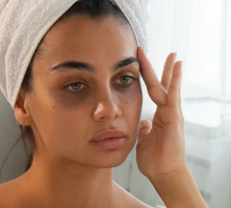 Femme avec cernes visibles sous les yeux, signes de fatigue, atténués naturellement avec l'huile de figue de barbarie Caudabio