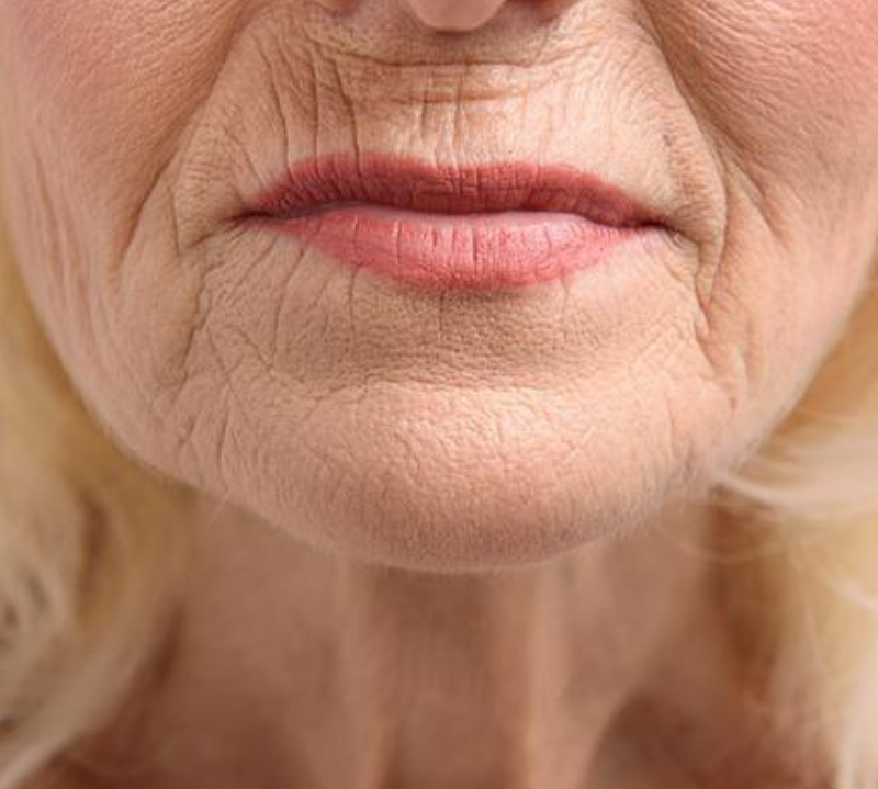 Qu'est-ce qui Cause les Rides Autour de la Bouche et du Sourire ? et comment les traiter naturellement.