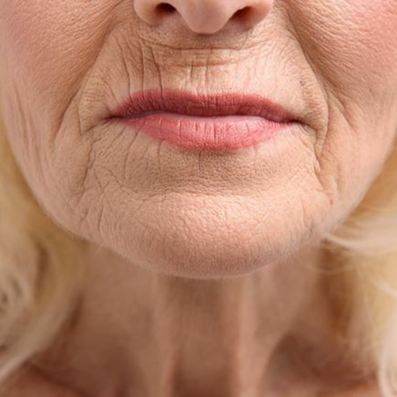 Qu'est-ce qui Cause les Rides Autour de la Bouche et du Sourire ? et comment les traiter naturellement.
