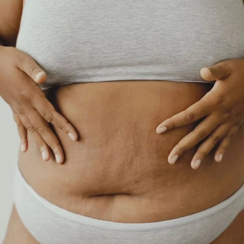 La peau des cuisses et du ventre peut se relâcher avec l’âge