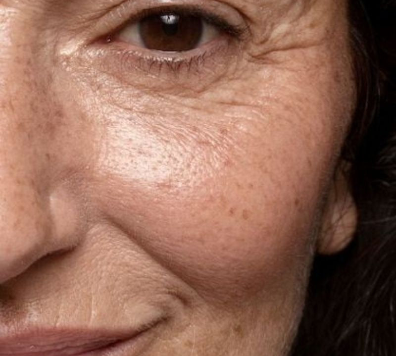 Relachement cutané visage