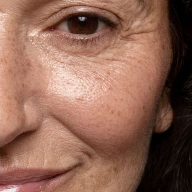 Relachement cutané visage